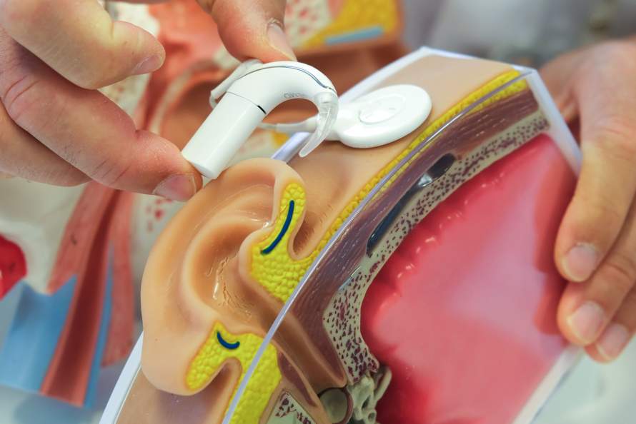 cochleair implantaat